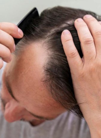 درمان ریزش مو، روش های جلوگیری از ریزش مو با استفاده از روغن‌های طبیعی